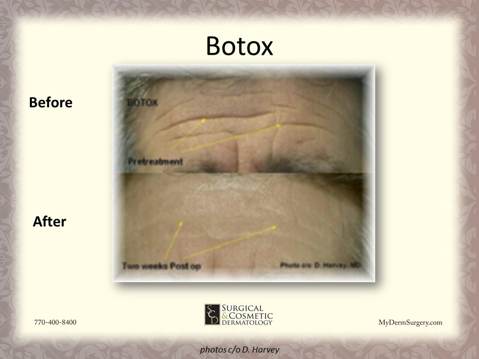 Forehead Botox - Cosmetic Injectables and Dermal Fillers Results Newnan