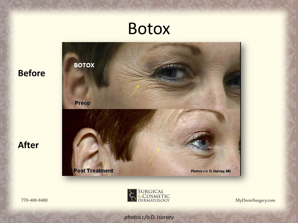 Botox - Cosmetic Injectables and Dermal Fillers Results Newnan
