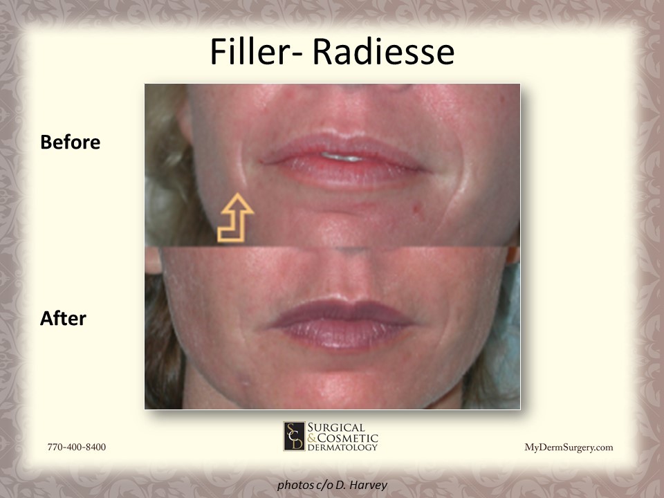 Smile Lines Radiesse Fillers - Cosmetic Injectables and Dermal Fillers Results Newnan