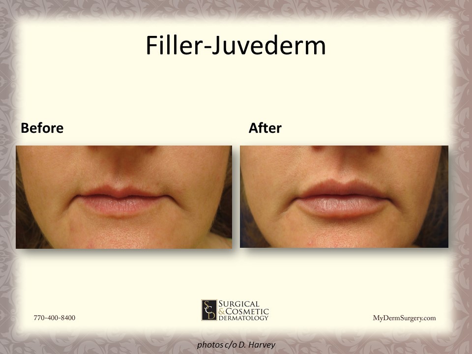 Photo Lips With Fillers - Cosmetic Injectables and Dermal Fillers Results Newnan