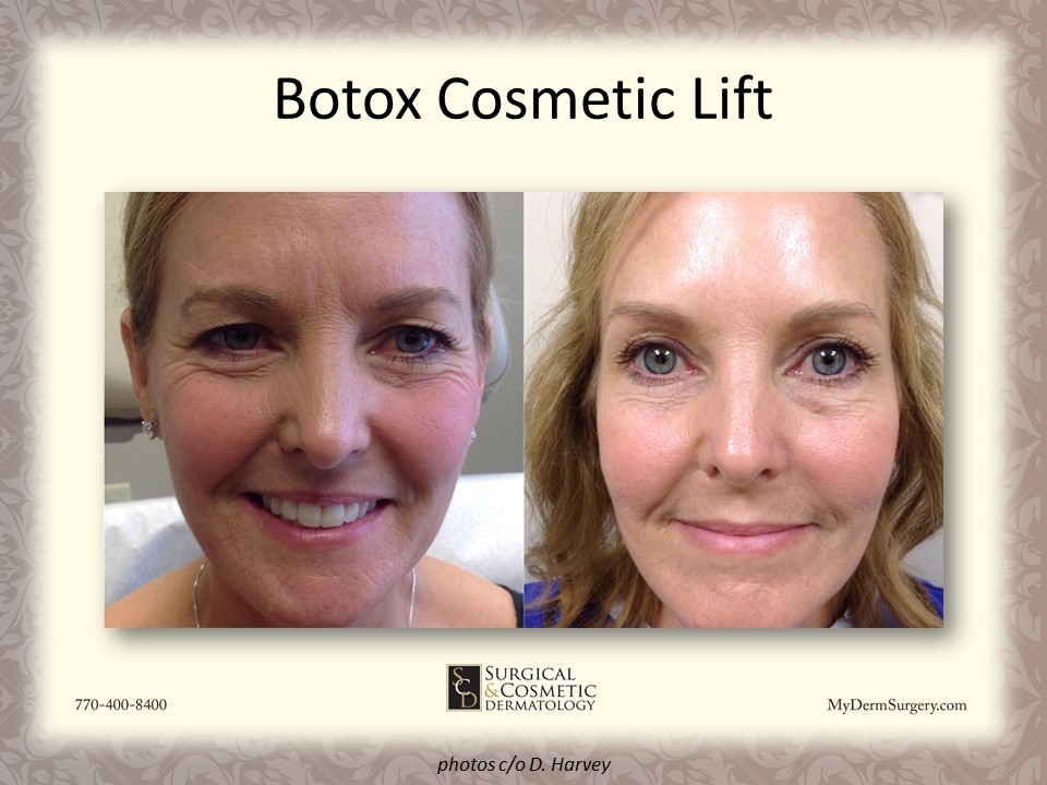 Cosmetic Lift With Botox Newnan GA Photo - Dermatology Institute for Skin Cancer and Cosmetic Surgery