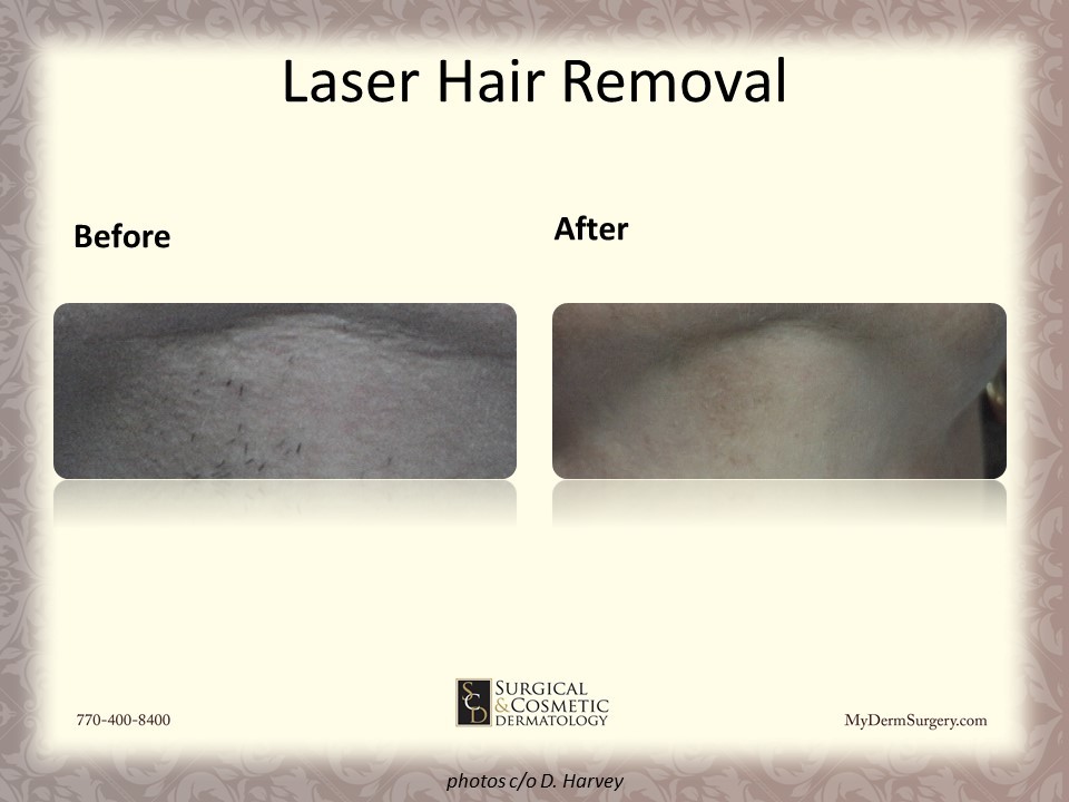 Laser Hair reduction Before & After