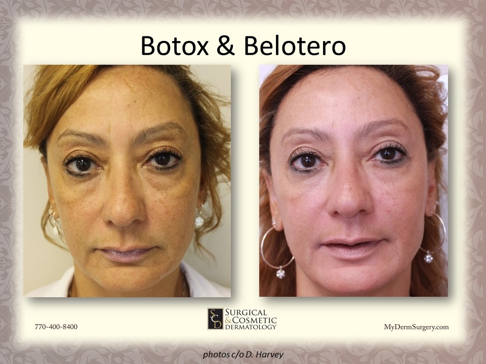 Belotero And Botox Newnan GA Image - Dermatology Institute for Skin Cancer and Cosmetic Surgery