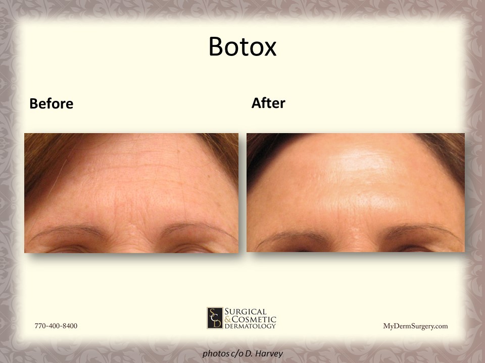 Forehead Lines With Botox - Cosmetic Injectables and Dermal Fillers Results Newnan
