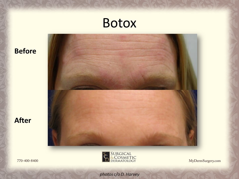 Forehead Botox Newnan GA Before/After Photo - Dermatology Institute for Skin Cancer and Cosmetic Surgery