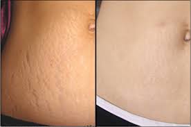 Stretch Mark Treatments Before & After