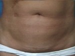 Liposuction