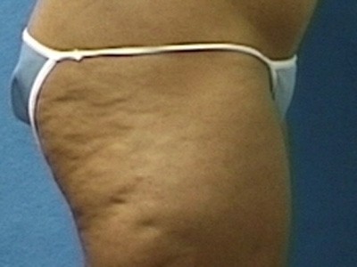 Liposuction