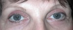 Eyelid Procedures