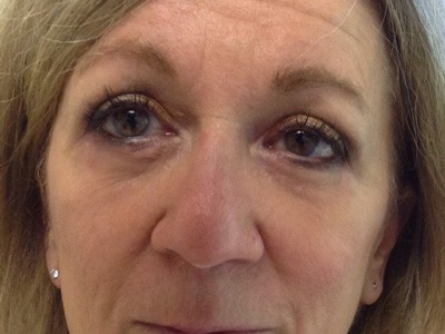 Eyelid Procedures