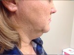 Face & Neck Tightening