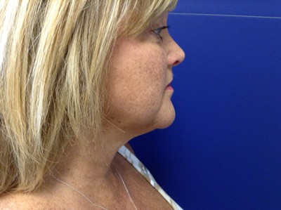 Face & Neck Tightening