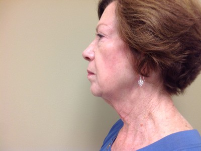 Face & Neck Tightening