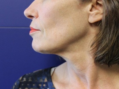 Face & Neck Tightening