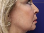 Face & Neck Tightening