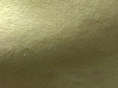 Laser Hair Removal