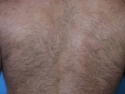 Laser Hair Removal