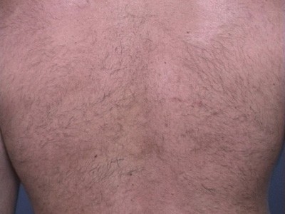 Laser Hair Removal