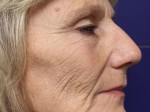 Laser Resurfacing