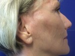 Laser Resurfacing