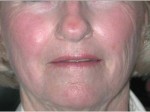 Laser Resurfacing