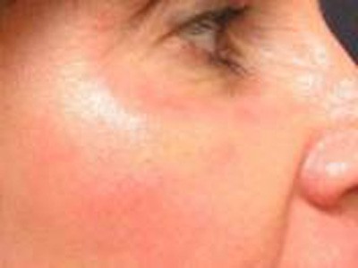 Laser Resurfacing