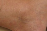 Sclerotherapy