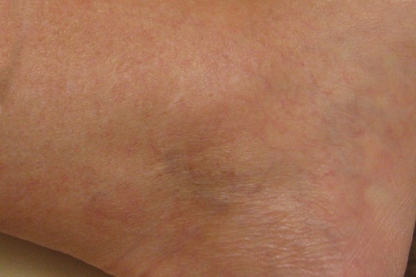 Sclerotherapy