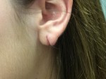 Earlobe Repair