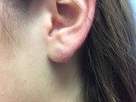 Earlobe Repair