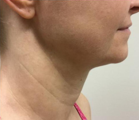 Face & Neck Tightening