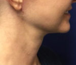 Face & Neck Tightening