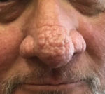 Rhinophyma