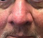 Rhinophyma