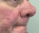 Rhinophyma