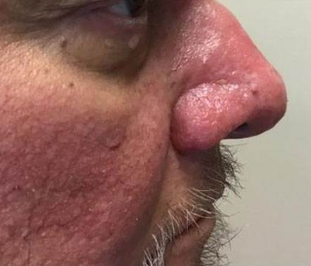 Rhinophyma