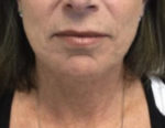 Face & Neck Tightening