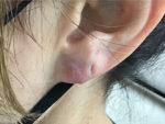 Earlobe Repair