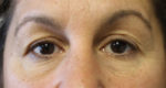 Eyelid Procedures