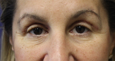 Eyelid Procedures