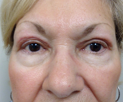 Eyelid Procedures