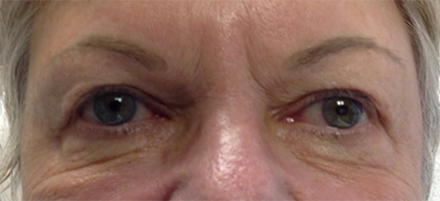 Eyelid Procedures