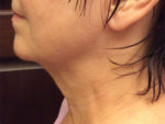 Face & Neck Tightening