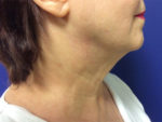 Face & Neck Tightening