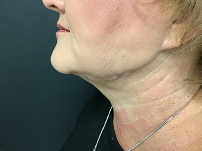 Face & Neck Tightening