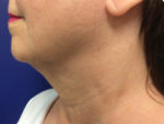 Face & Neck Tightening