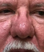 Rhinophyma