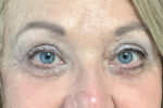 Eyelid Procedures