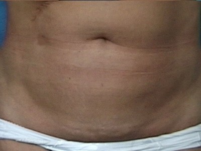 Liposuction Before & After