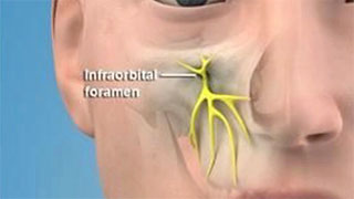 Infraorbital Nerve Block